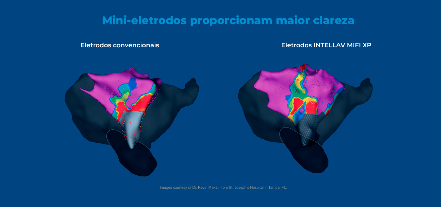 A comparison map shows the enhanced clarity offered by INTELLANAV MIFI XP Ablation Catheter electrodes versus standard electrodes.