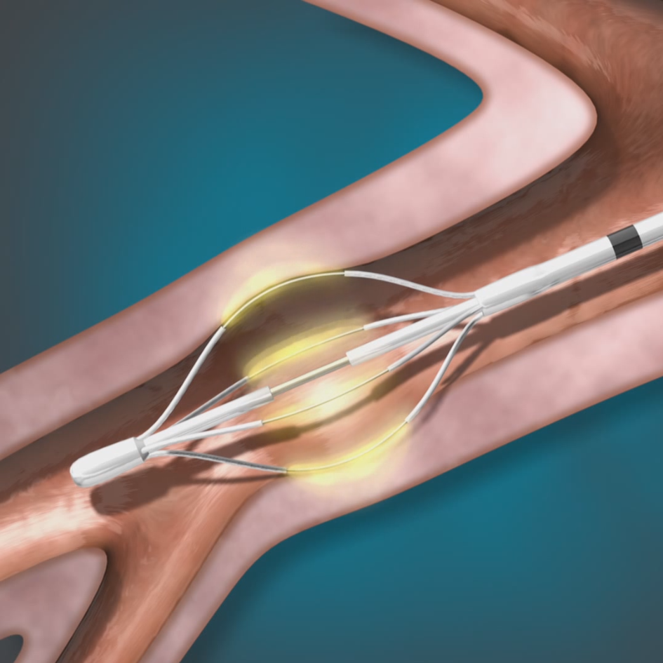 The Alair&trade; Bronchial Thermoplasty System