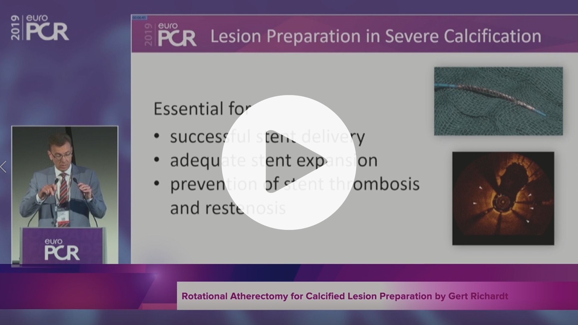 SYNTAX II Rotational Atherectomy for Calcified Lesion Preparation by Gert Richardt, VIdeo