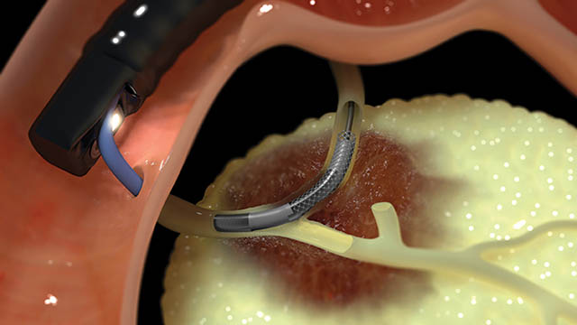 Habib Animation in Stricture