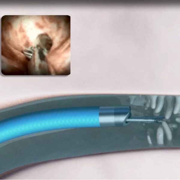 SpyGlass™ DS Direct Visualization System Boston Scientific Boston