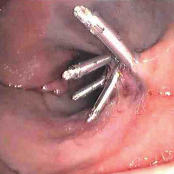 Image of Mucosal Defect Closure using Resolution Clips