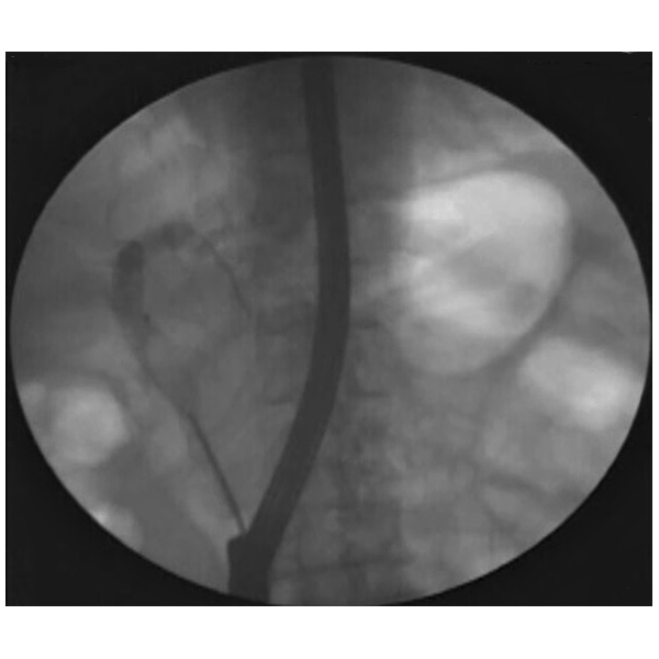 Fluoroscopy image showing Trapezoid RX Retrieval Basket capturing a stone in the common bile duct (CBD)