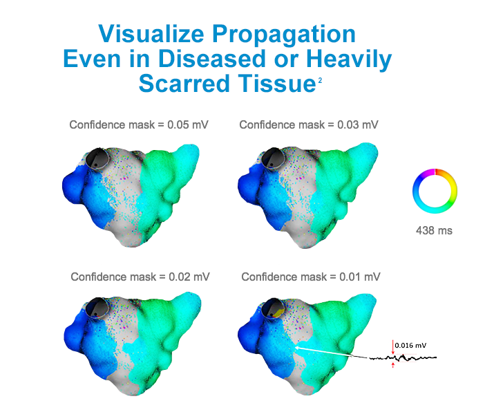 High-definition maps show how RHYTHMIA helps you visualize propagation even in diseased or heavily scarred tissue.