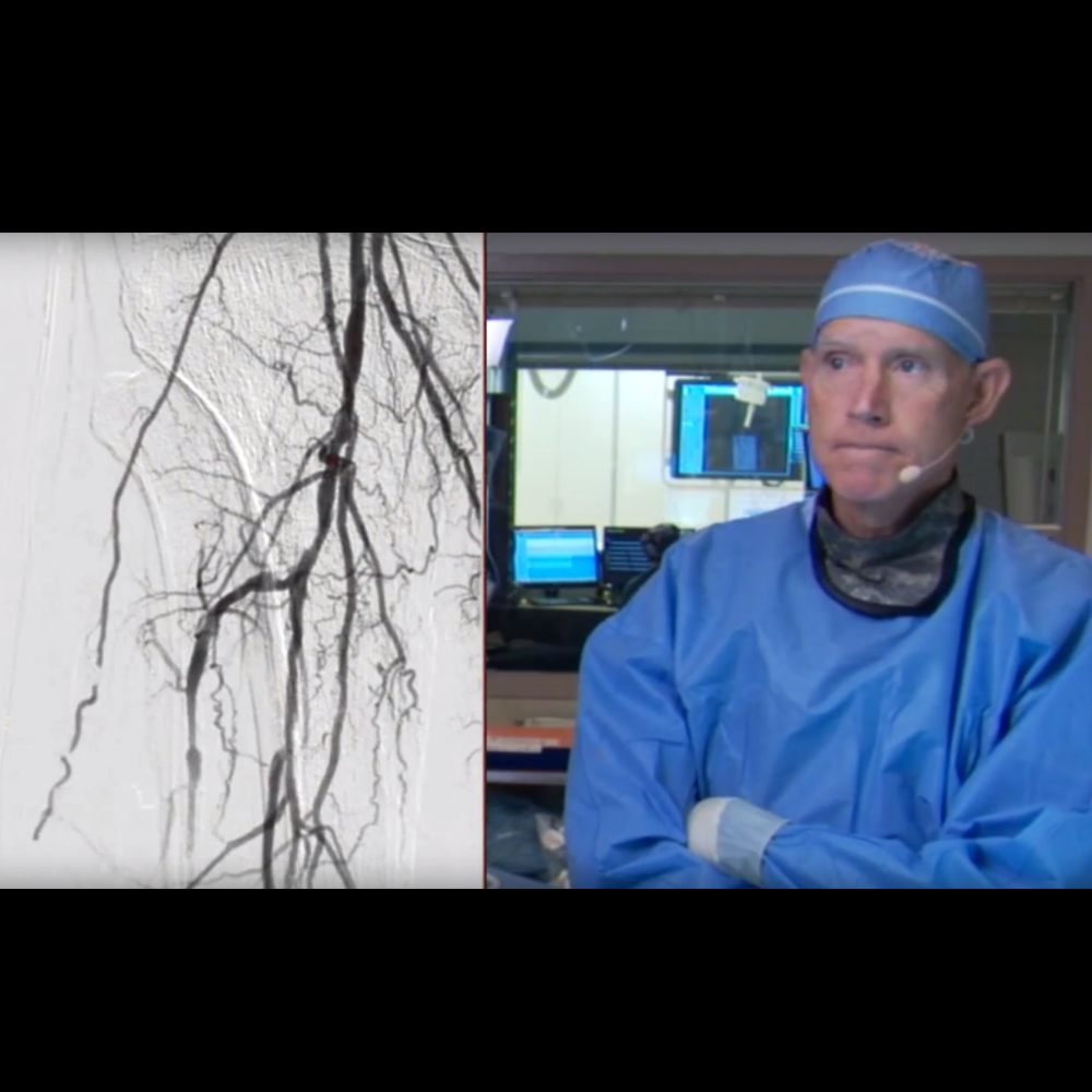 Watch Single Vessel Revascularization Using Rotablator Atherectomy in a CLI Patient.