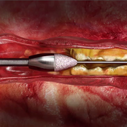 See the Peripheral Rotablator Atherectomy System Mechanism of Action.