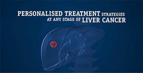 Personalised Treatment Strategies - Liver Cancer