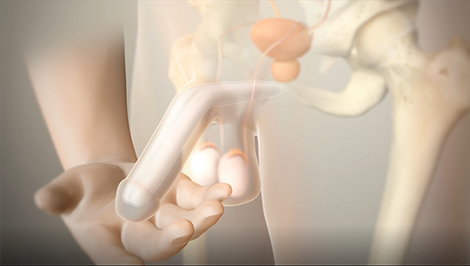 Tactra Malleable Penile Prosthesis Animation