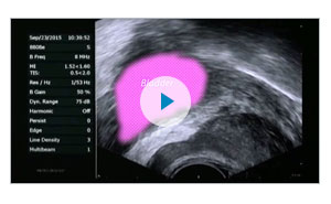 Video thumbnail of medical screen focused on the prostate.