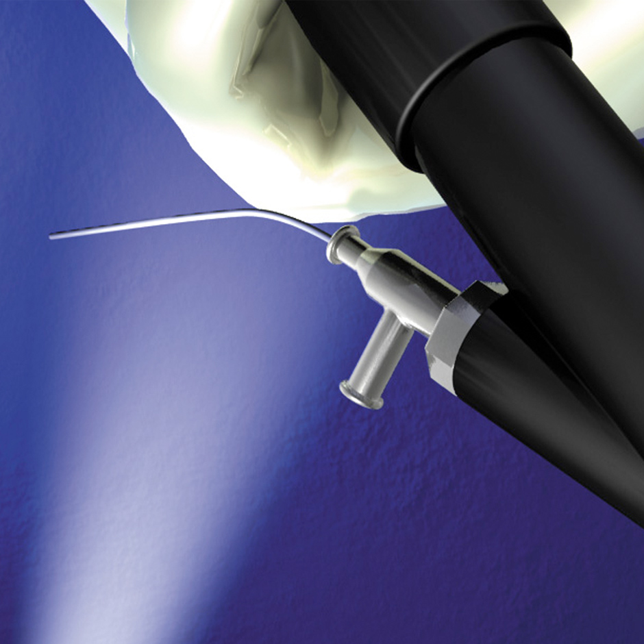 Sensor Dual Flex Projetado para facilitar a passagem no ureteroscópio flexível.