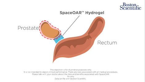 SpaceOAR™ Hydrogel Short Clip video.