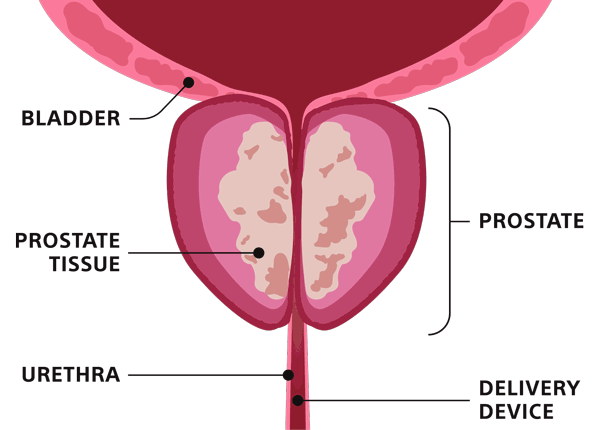 animation of rezum procedure in the prostate