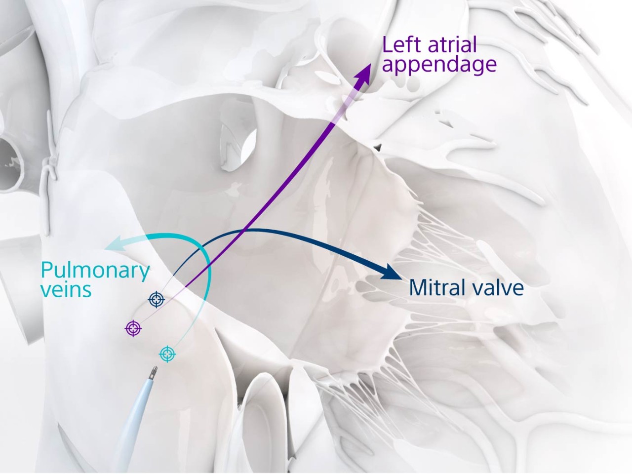 NRG Transseptal Needle with arrows to pulmonary veins, left atrial appendage, and mitral valve.