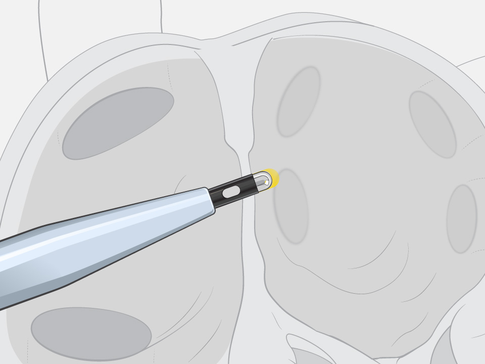 VersaCross Connect LAAC Access Solution with lines highlighting smooth transition between dilator and WATCHMAN Access Sheath.