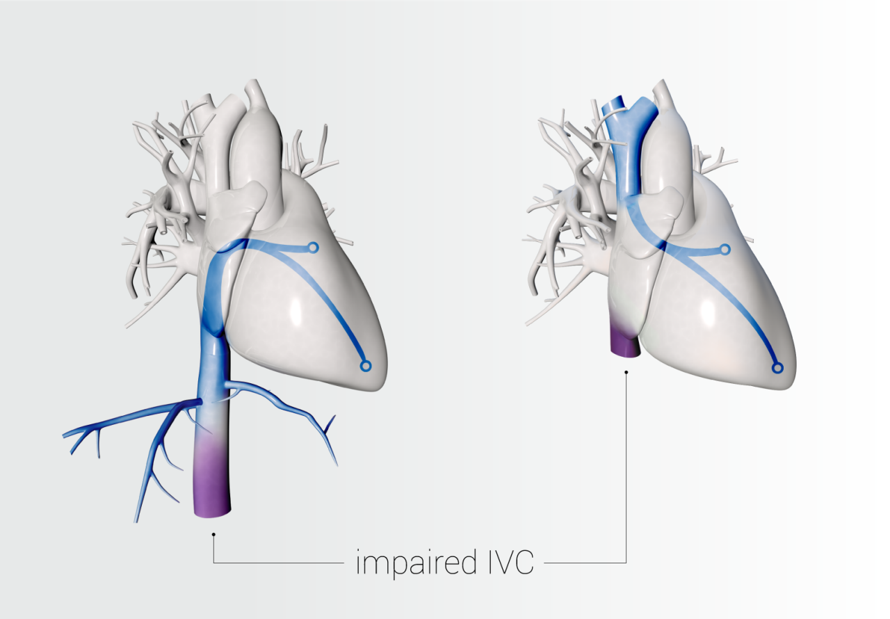 Diagrams of the heart highlighting venous access routes to the left atrium and implying an impaired inferior vena cava.