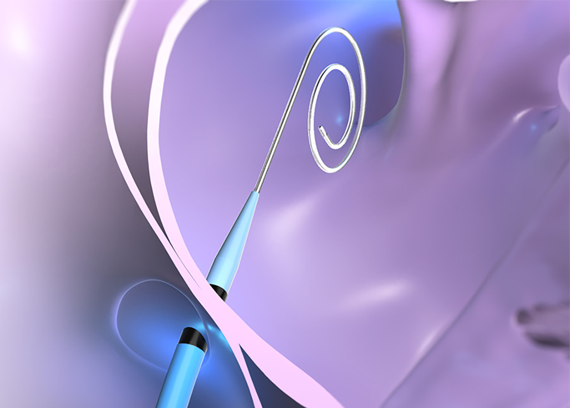 VersaCross Connect Transseptal Dilator with 3-in-1 pigtail RF wire extending from POLARSHEATH Steerable Sheath.