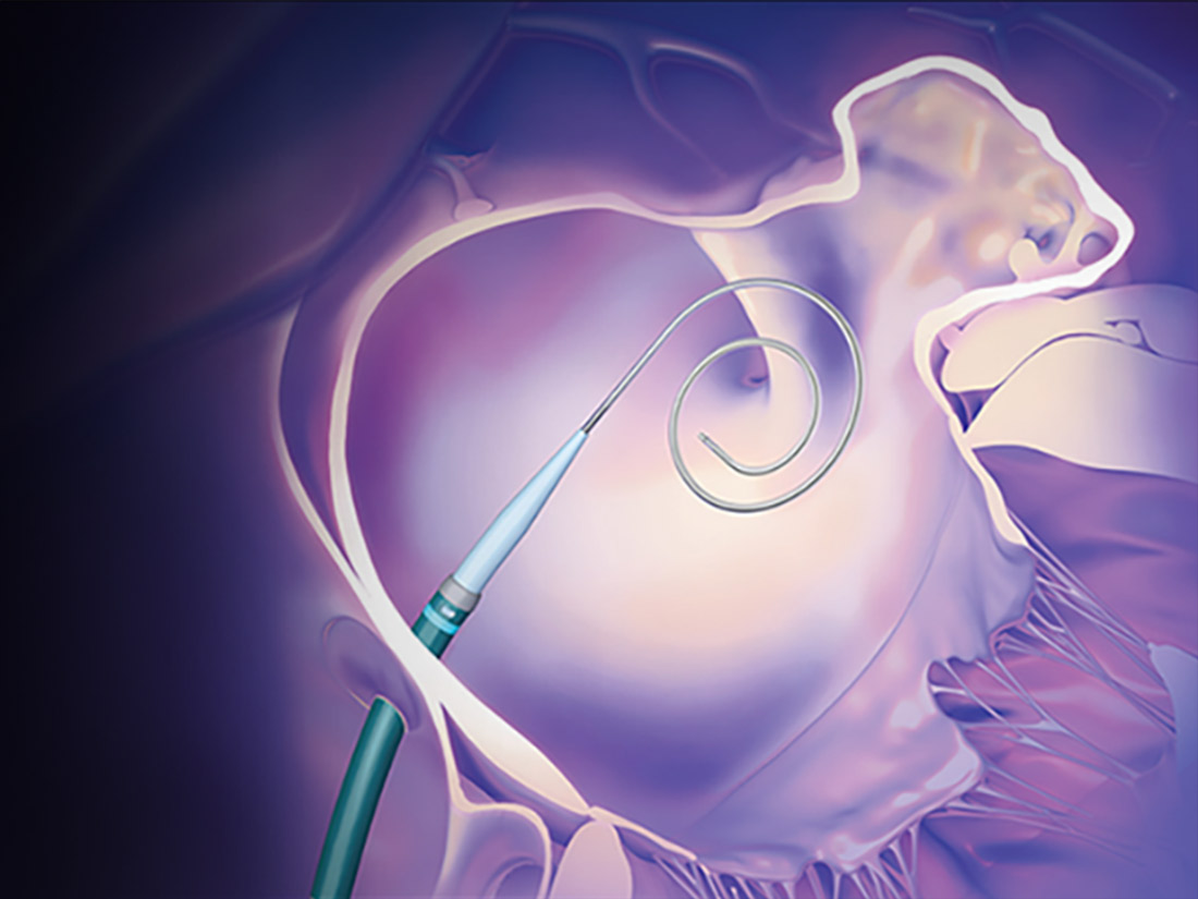 VersaCross Connect Transseptal Dilator with 3-in-1 RF wire.