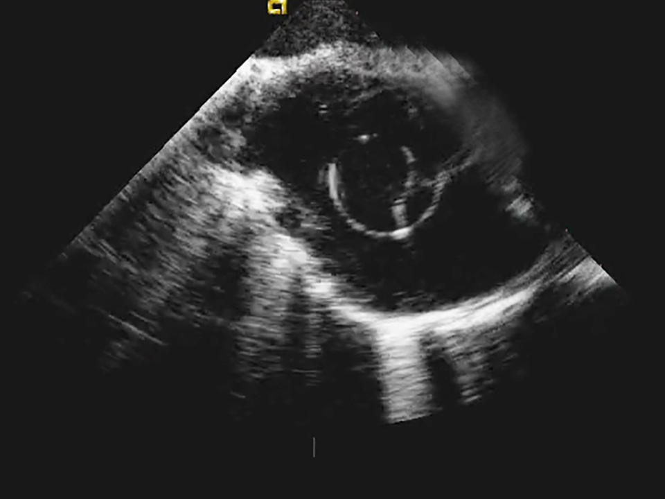 Image demonstrating that VersaCross Access Solution is echogenic.