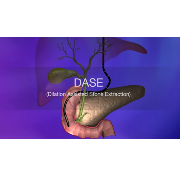 Dilation Assisted Stone Extraction (DASE)