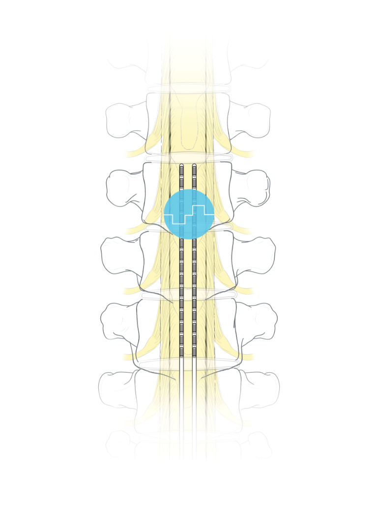 Spinal Cord Stimulation illustration 
