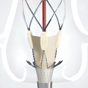 ACURATE neo2™  Aortic Valve System showing Precise positioning  mechanism