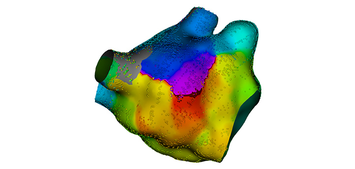 RHYTHMIA HDx™ Mapping System. Activation map courtesy of Dr. Elad Anter, Beth Israel Deaconess Medical Center. 