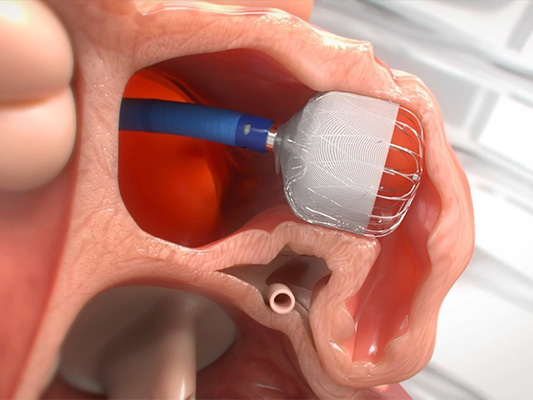 Animation of Boston Scientific WATCHMAN FLX being placed within heart valve.