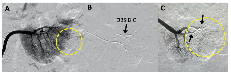 Medical scans showing arteries before and after with Obsidio, delivery achieving absence of flow in the blood vessel of tumor and no migration of Obsidio Embolic (Day 7).