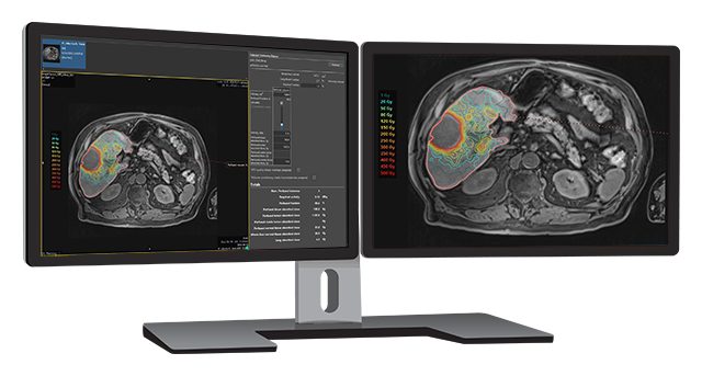 Double desktop monitor showing Simplicit90Y personalized dosimetry software for TheraSphere Y-90 Glass Microspheres.