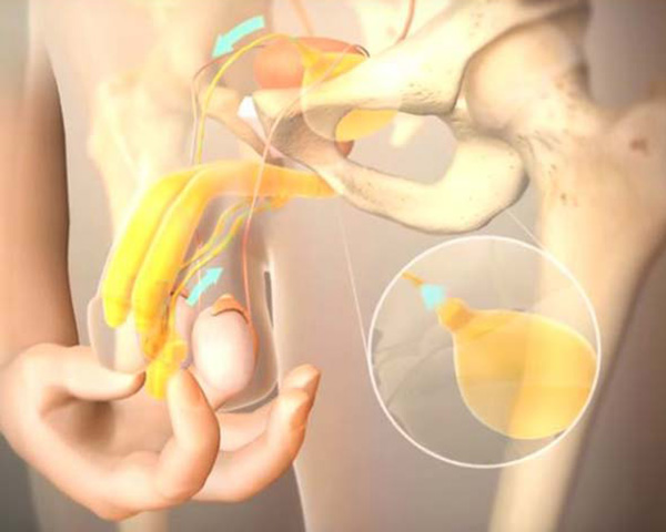 AMS 700™ Inflatable Penile Prosthesis animation video still.
