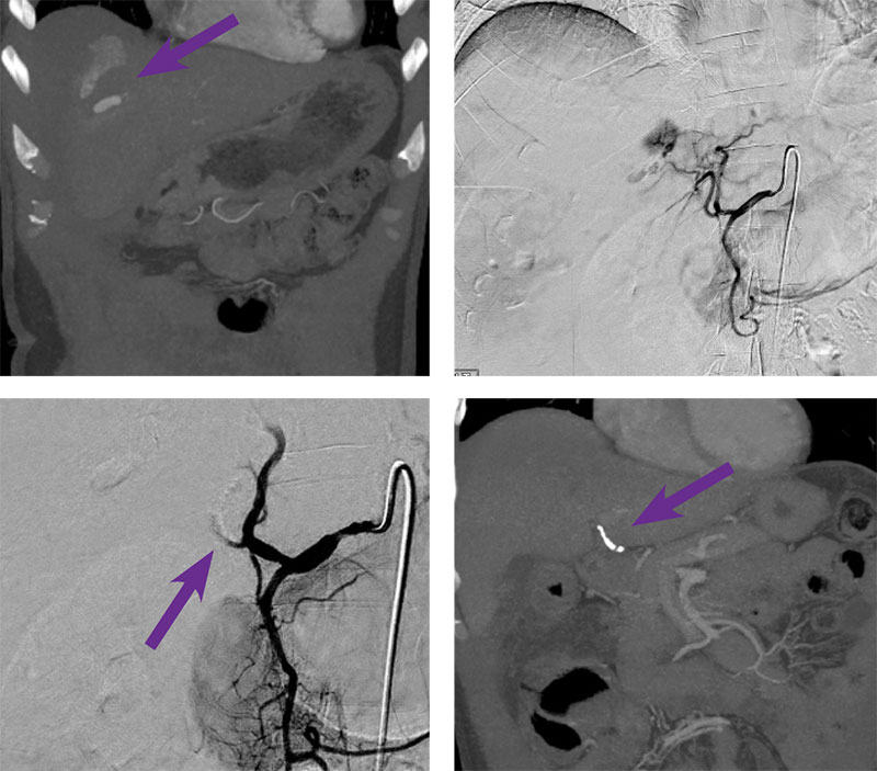 Purple arrows pointing to hepatic artery embolization with Obsidio.