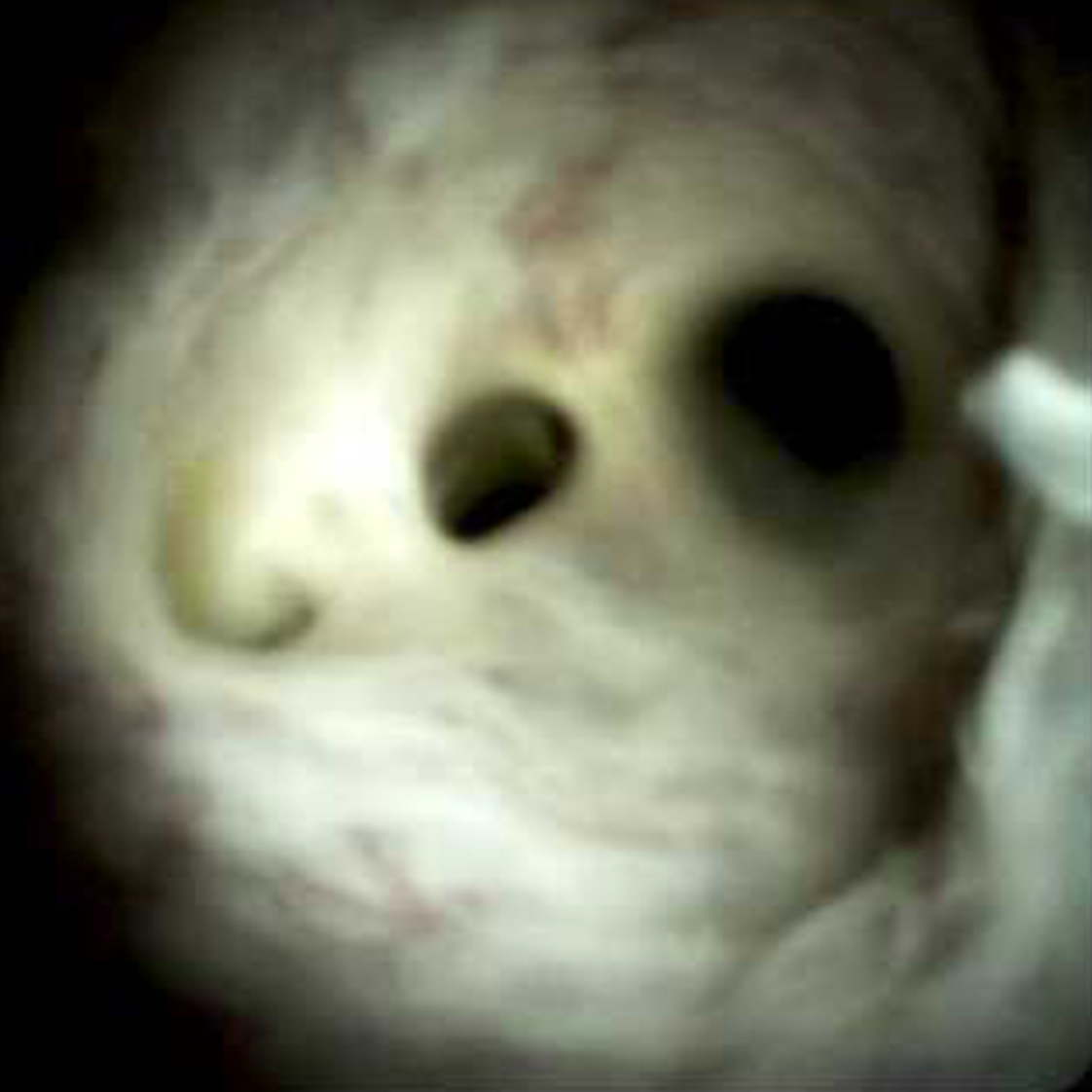 Clinical image of Portal vein thrombosis and cholangiopathy (DS I).