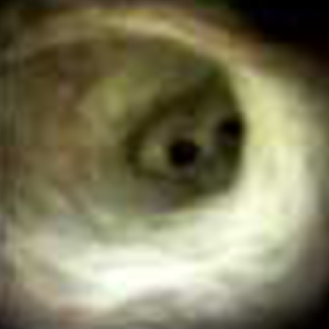 Clinical image of Portal vein thrombosis and cholangiopathy (DS I).