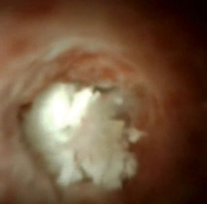 Clinical image of pancreatic duct stone.