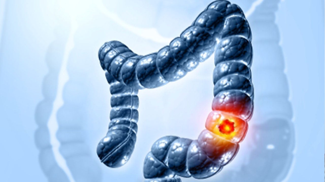 Digital illustration of colon cancer tumor