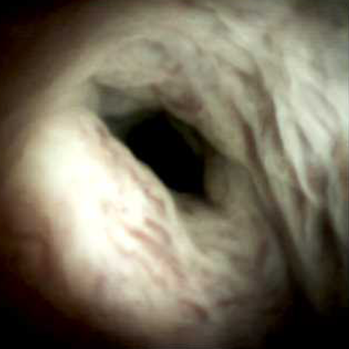 Clinical image of Portal vein thrombosis and cholangiopathy (DS I).