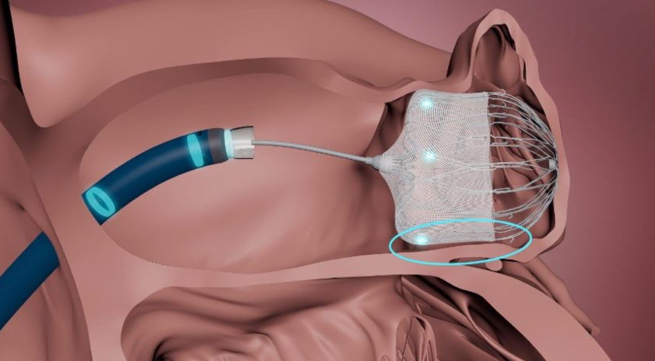 WATCHMAN TruSteer Access System placing WATCHMAN device