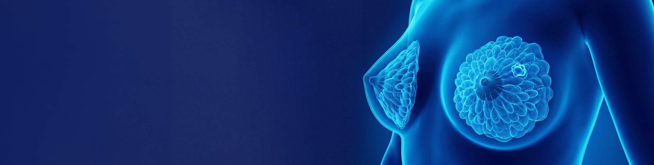 Breast cancer