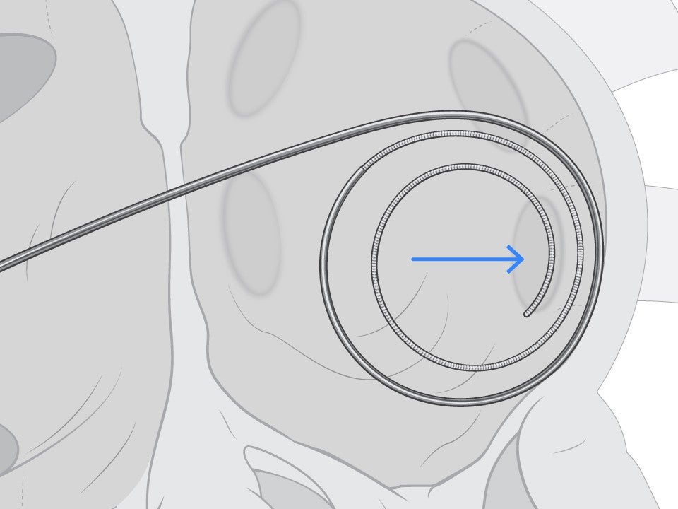 ProTrack Pigtail Wire cushioned against the left atrial wall.