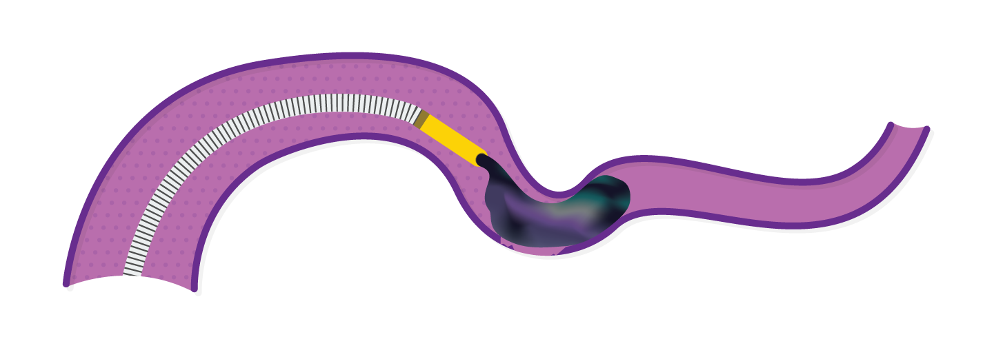 Obsidio conformable fast injection deployment mid delivery.