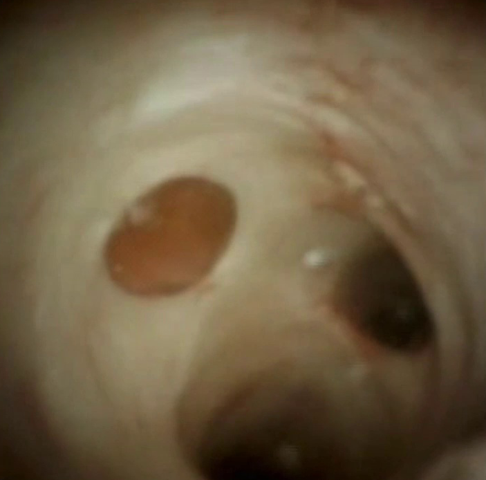 Clinical image of pancreatic duct and side branches.