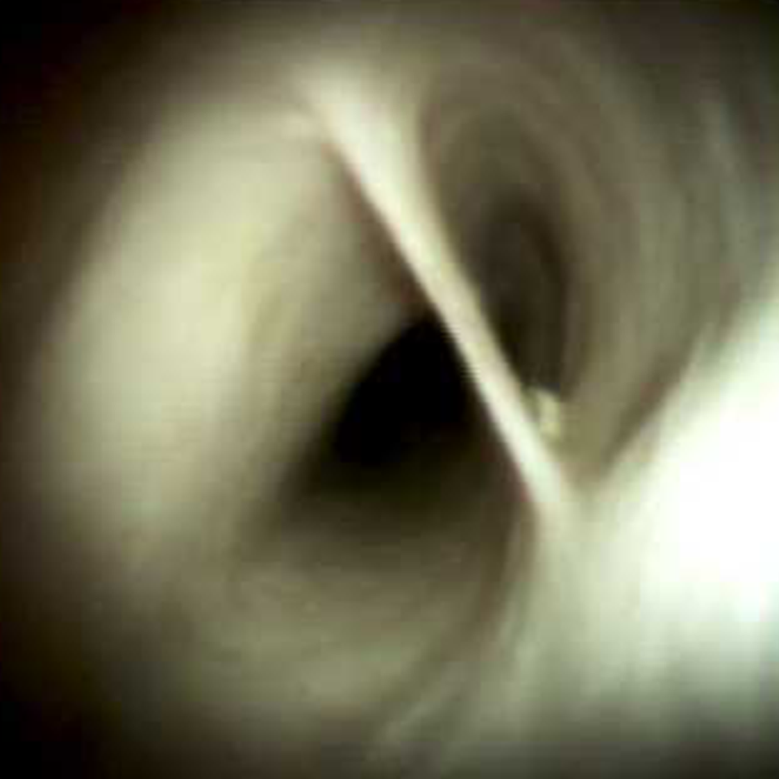 Clinical image of Normal cystic duct common bile duct junction (DS I).