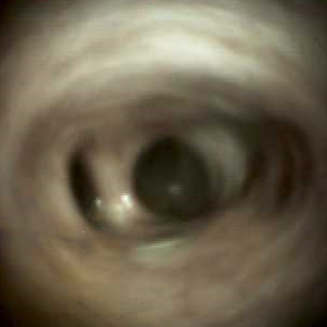 Clinical image of Filling defects showing surgical staples II (DS I).