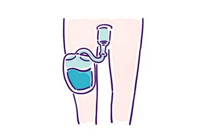 脚に蓄尿袋を装着するレッグバッグ