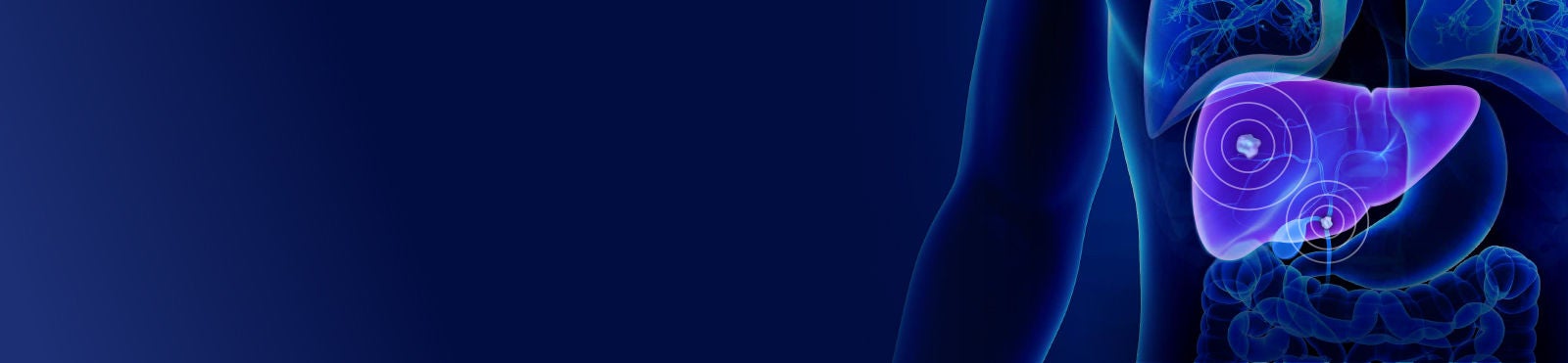 Internal view of patient's torso demonstrating targeted accuracy of TheraSphere Y-90 Glass Microspheres in liver.