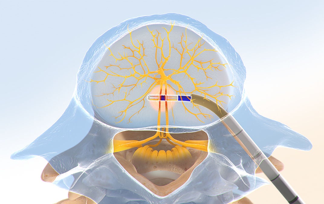Probe delivering targeted energy to basivertebral nerve inside vertebral body.