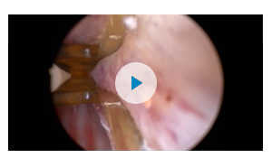 Still from video. View a median lobe procedural video.