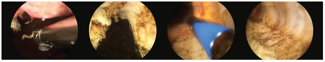 4 scope images. Which are illustrating how to debulk the prostate.
