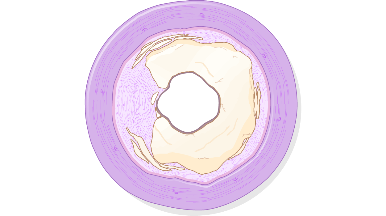 Coronary artery showing severe concentric calcium.