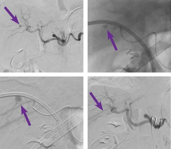 Hepatic artery pseudoaneurysm embolization Obsidio™ Embolic Case ...
